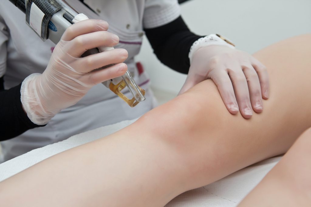 epilation laser homme